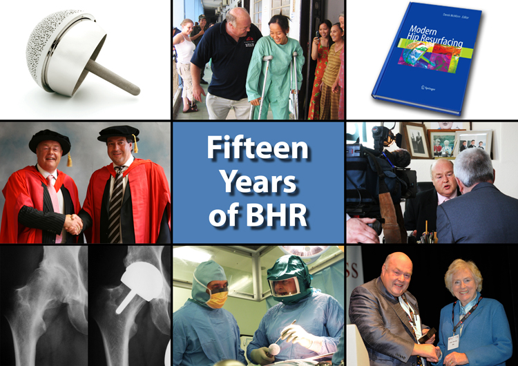 fifteen year birmingham hip resurfacing anniversary